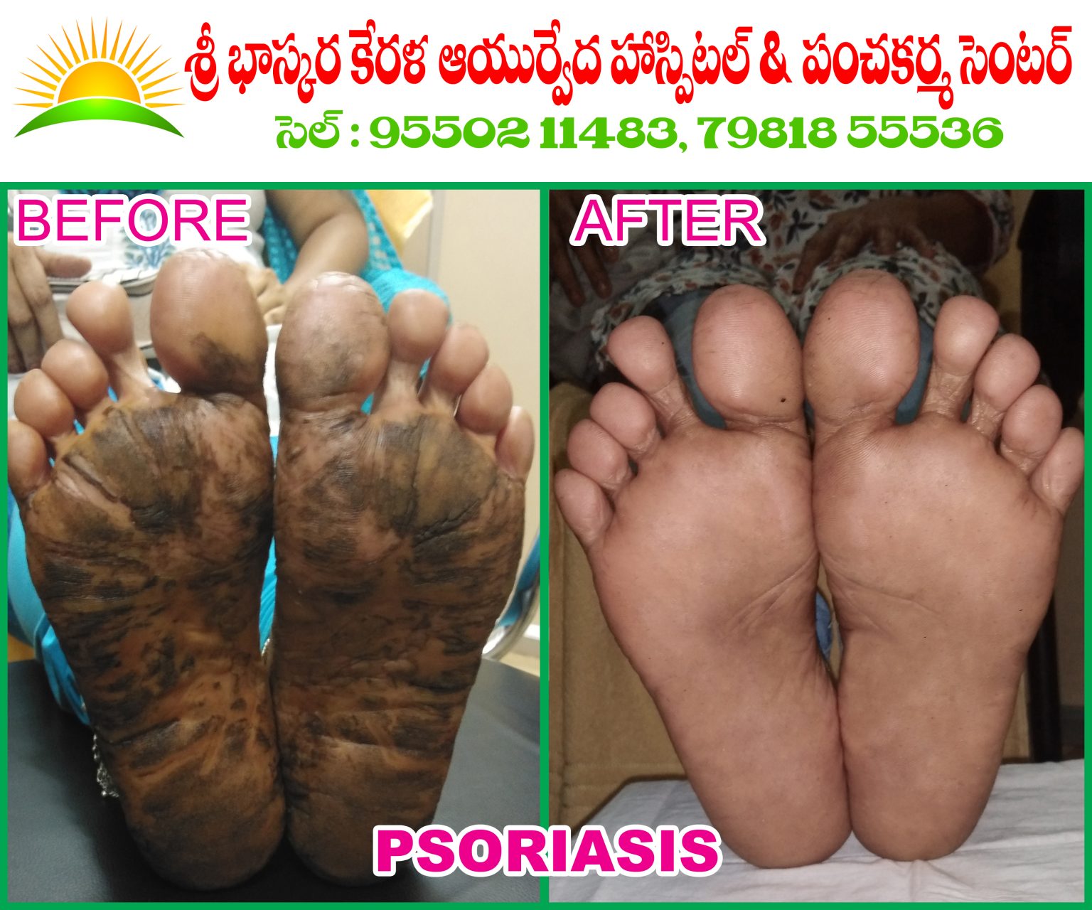 Psoriasis Sri Bhaskara Kerala Ayurvedic Hospitals