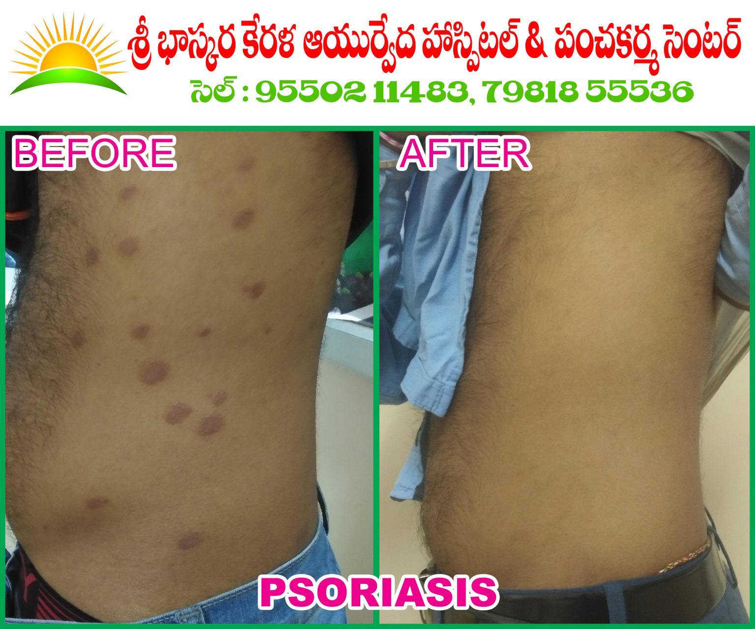 Psoriasis Sri Bhaskara Kerala Ayurvedic Hospitals